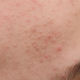 Illustration for article titled Acne Has Taunted Women Since The Dawn Of Time
